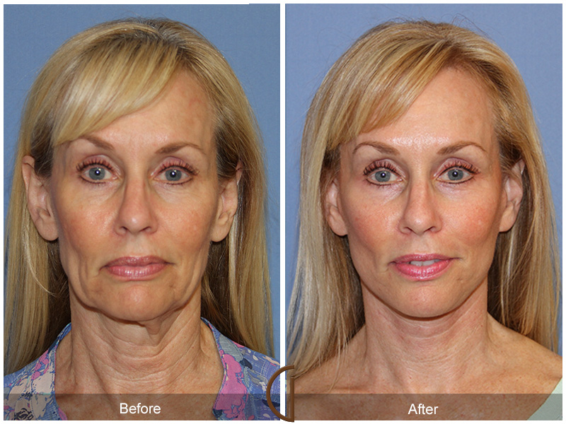 Before and after gallery for Orange County, Newport Beach facial plastic surgeon Dr. Kevin Sadati