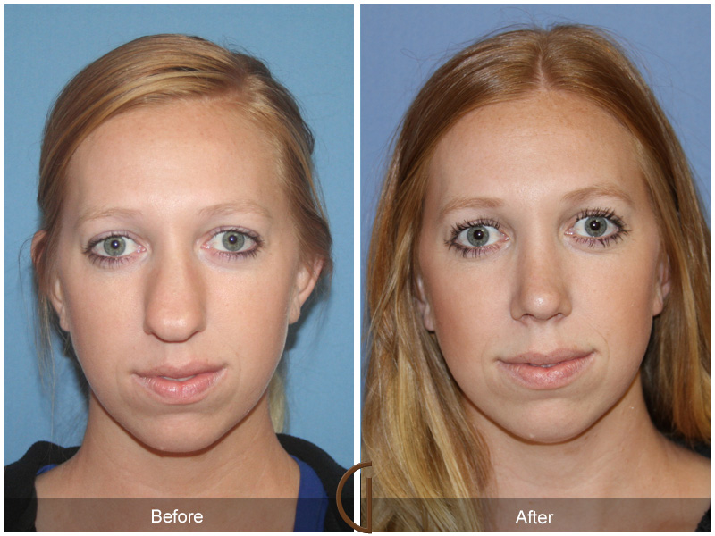 Before and after gallery for Orange County, Newport Beach facial plastic surgeon Dr. Kevin Sadati