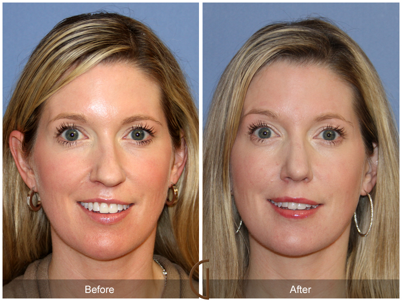 Before and after gallery for Orange County, Newport Beach facial plastic surgeon Dr. Kevin Sadati